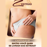 Desvendando as Estrias: Guia Completo para Prevenção e Tratamento"